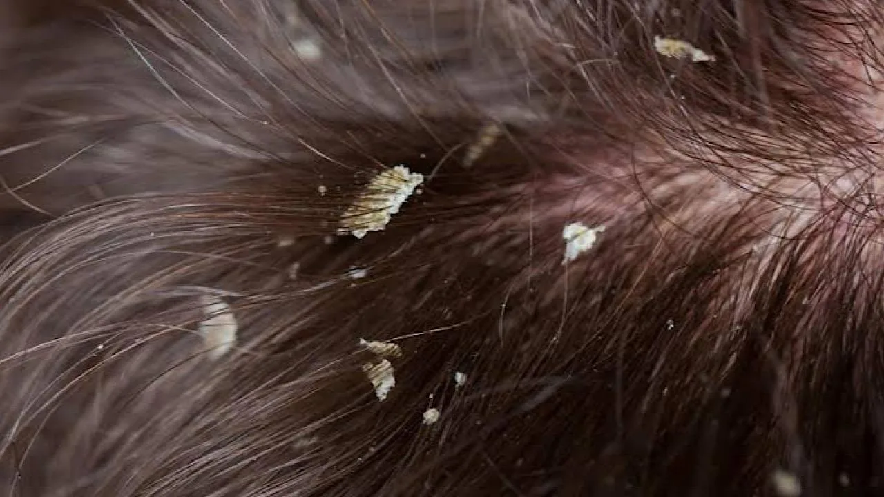 القشرة الدهنية