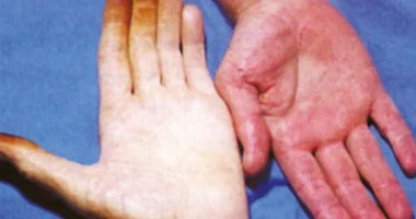 فقر الدم: كل ما تحتاج معرفته عن هذا المرض الشائع