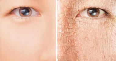 جفاف البشرة