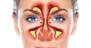 من نزلة برد إلى التهاب الجيوب الأنفية: تعرف على الأعراض وكيفية التعامل معها
