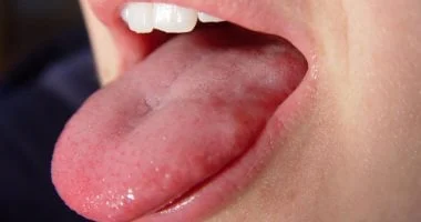 اصفرار اللسان: ما أسبابه ومتى يجب القلق؟ 