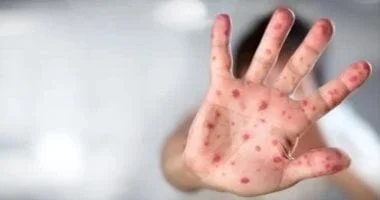 اكتشاف متحور جديد من فيروس جدرى القرود فى إنجلترا 