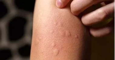 باحثون يطورون لقاحاً يحمي من الحساسية 