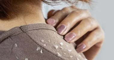 علاجات منزلية لإزالة قشرة الشعر بطرق طبيعية وتحضيرها 