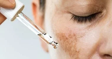 وصفات طبيعية سهلة لإزالة البقع الداكنة الناتجة عن حب الشباب 