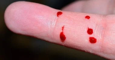 مراهق روسي يتسمم بعد شرب دمه لرفع مستوى الحديد 