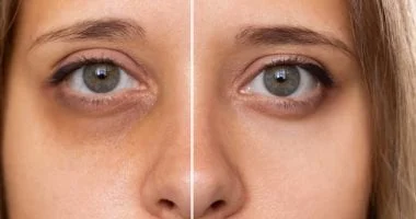 وصفات طبيعية لإزالة الهالات السوداء 