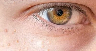 مشكلات صحة العين في 2025 نتيجة نمط الحياة الحديث وسبل الوقاية 