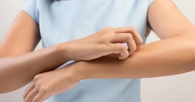 تحذيرات في المملكة المتحدة من مرض جلدي شديد العدوى: ما هو؟ 