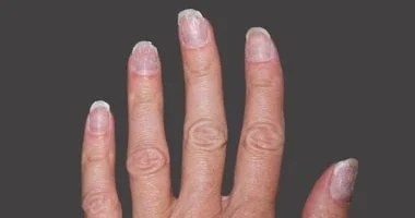 لون أظافرك وما يكشفه عن صحتك ومتى يجب زيارة الطبيب 