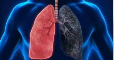 عدوى الرئة الفطرية الصامتة: ما هو داء الرشاشيات؟ 