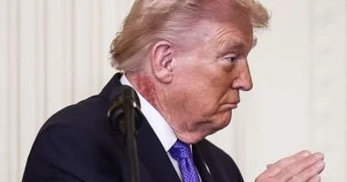 احمرار وتقشير في الرقبة لدى ترامب.. أطباء يكشفون سبب الطفح 